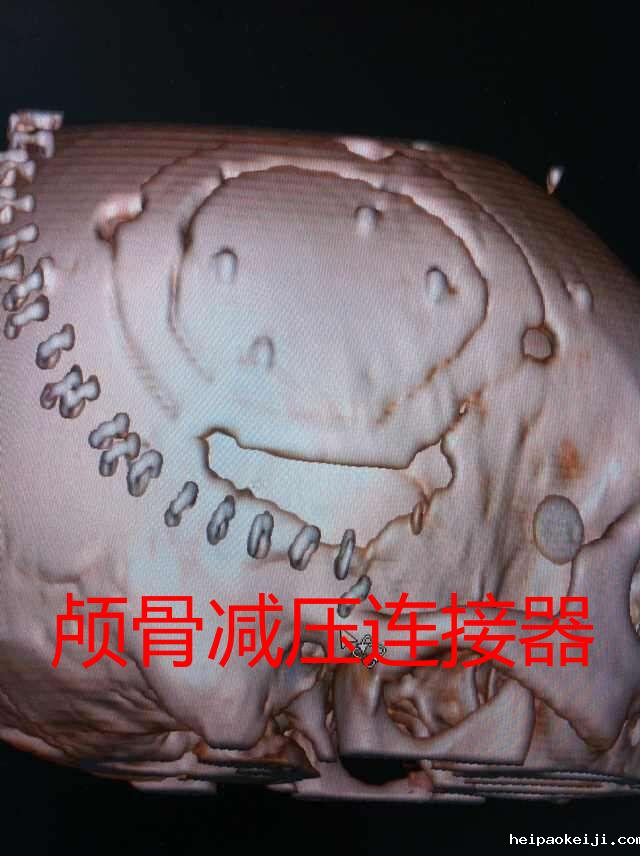 颅骨减压连接器及系列神经外科新产品